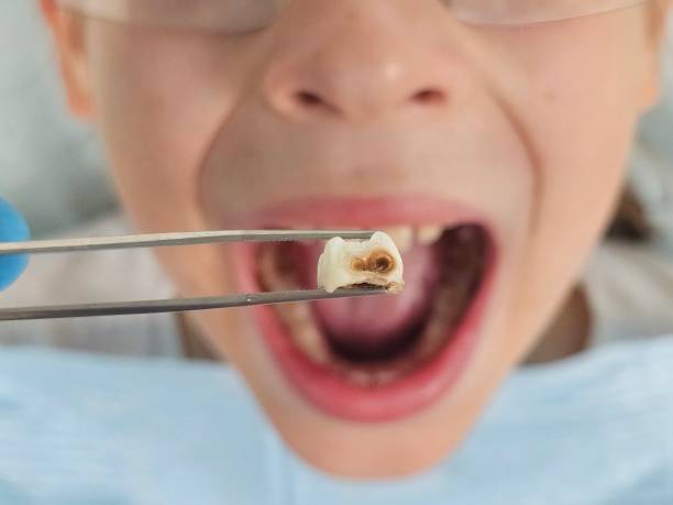 Best Mobile Emergency Dentist in Decordova, TX