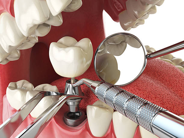 Best Emergency Dental Extractions in Decordova, TX